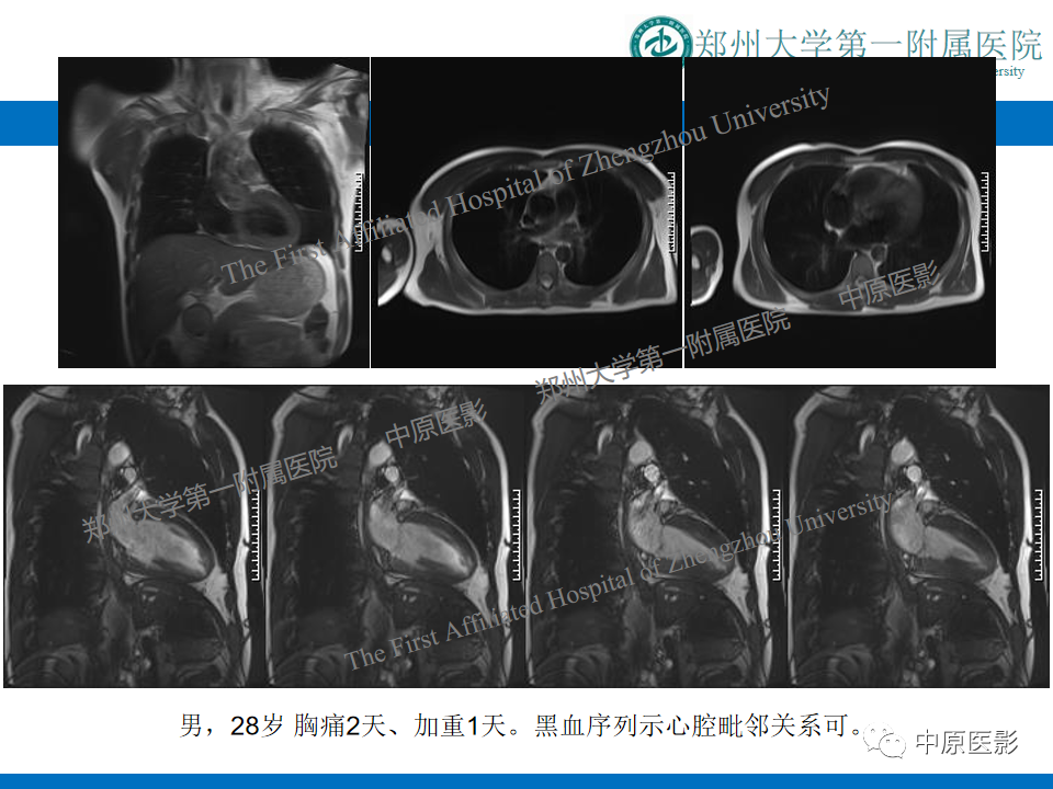 影像PPT - 【病例】致心律失常性右室心肌病1例MR影像-18