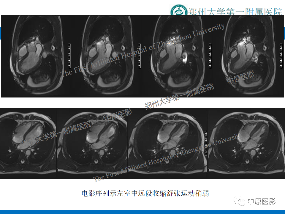 影像PPT - 【病例】致心律失常性右室心肌病1例MR影像-19