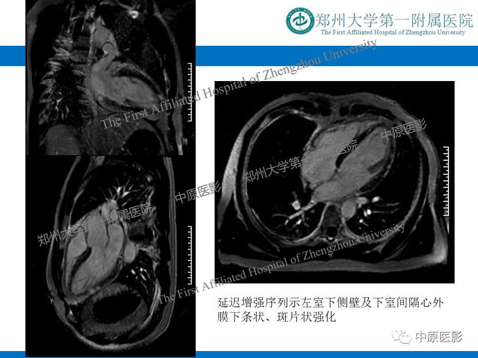 影像PPT - 【病例】致心律失常性右室心肌病1例MR影像-23