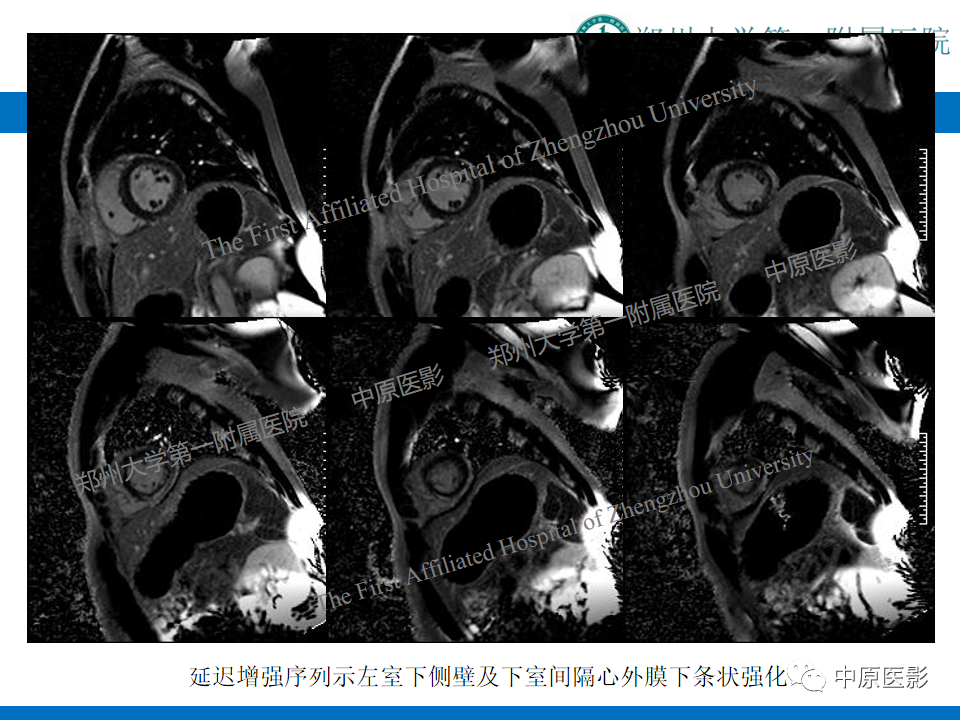 影像PPT - 【病例】致心律失常性右室心肌病1例MR影像-22