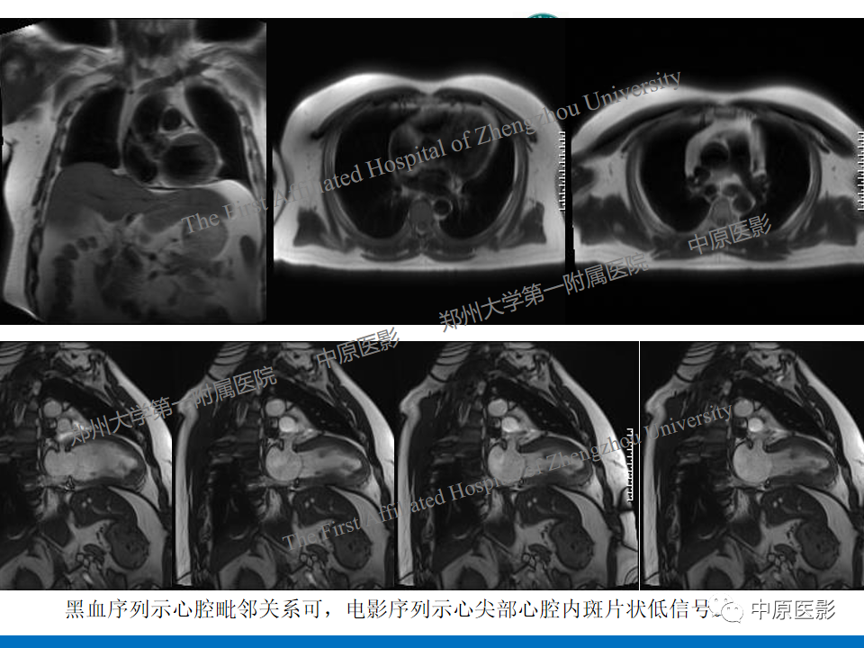影像PPT - 【病例】致心律失常性右室心肌病1例MR影像-26