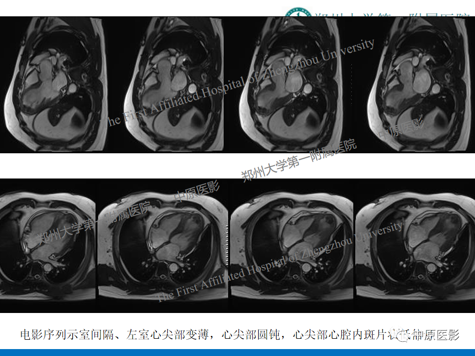 影像PPT - 【病例】致心律失常性右室心肌病1例MR影像-27