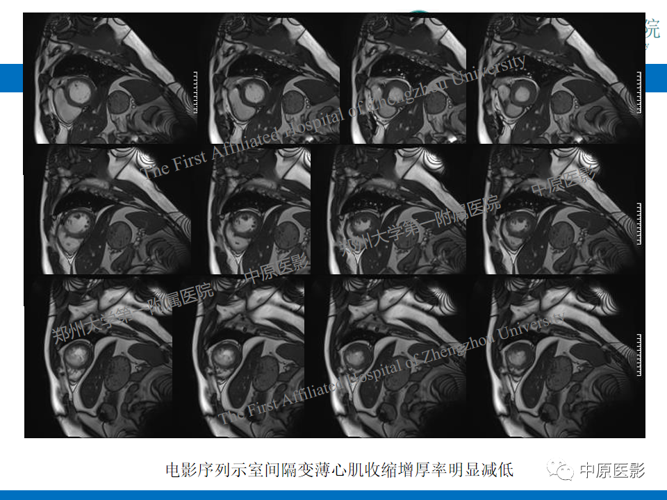 影像PPT - 【病例】致心律失常性右室心肌病1例MR影像-28