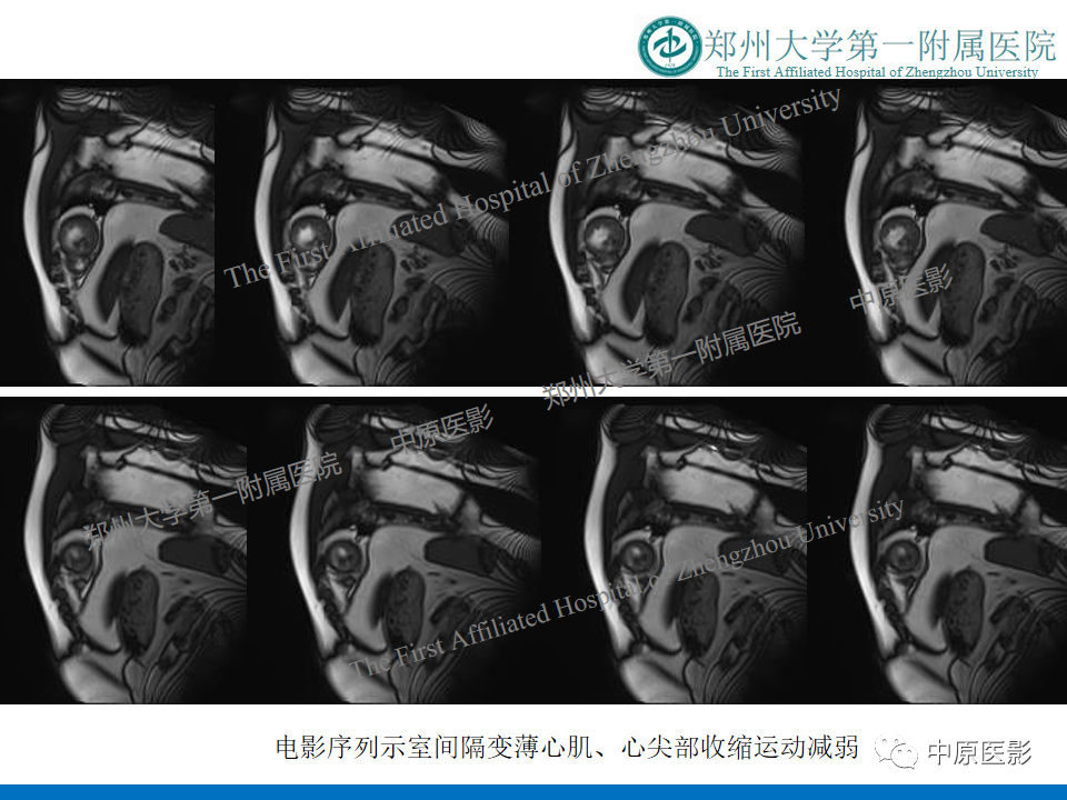 影像PPT - 【病例】致心律失常性右室心肌病1例MR影像-29