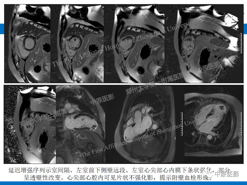 影像PPT - 【病例】致心律失常性右室心肌病1例MR影像-31