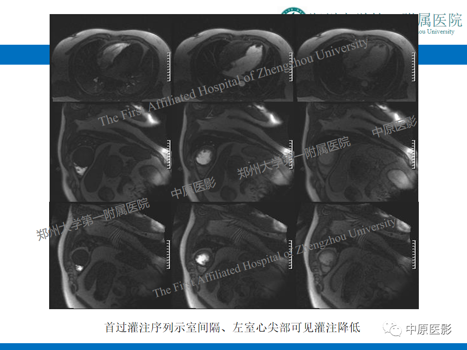 影像PPT - 【病例】致心律失常性右室心肌病1例MR影像-30