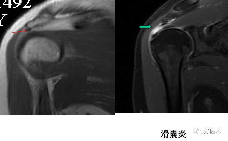 影像PPT - 肩关节损伤的影像学诊断-30 影像PPT - 肩关节损伤的影像学诊断-30