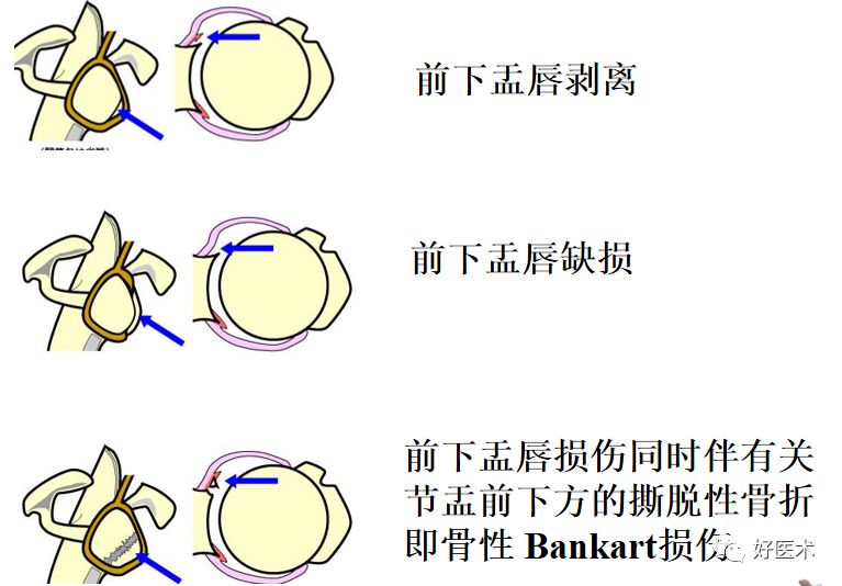影像PPT - 肩关节损伤的影像学诊断-46 影像PPT - 肩关节损伤的影像学诊断-46