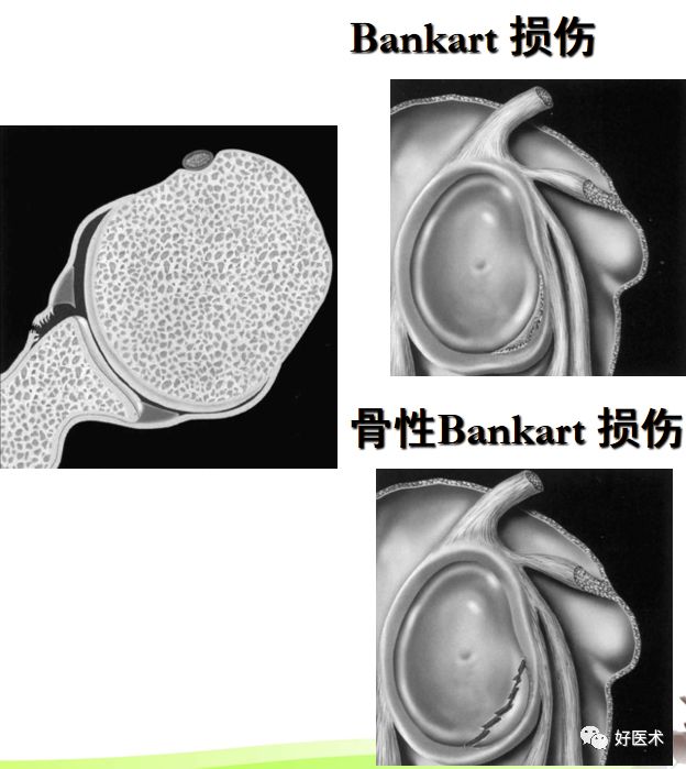 影像PPT - 肩关节损伤的影像学诊断-47 影像PPT - 肩关节损伤的影像学诊断-47