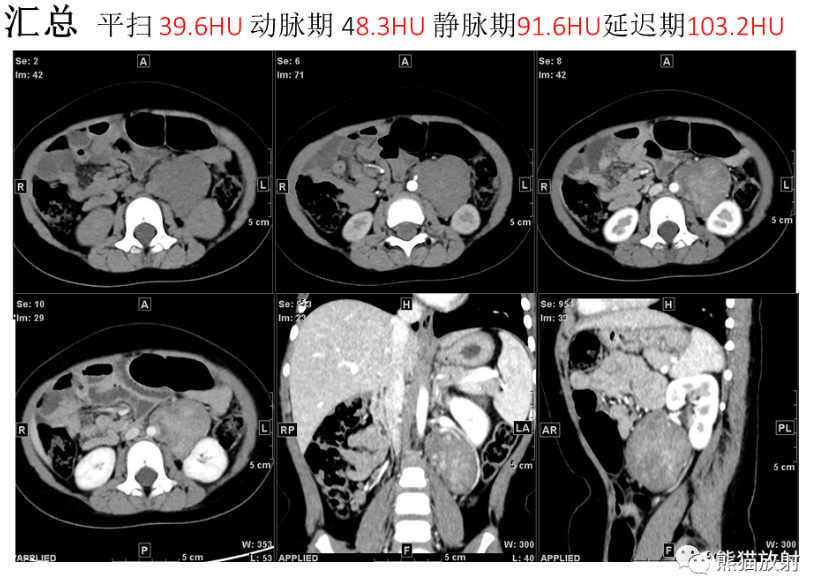 影像PPT - 【病例】肾上腺节细胞神经母细胞瘤1例CT影像-6 影像PPT - 【病例】肾上腺节细胞神经母细胞瘤1例CT影像-6