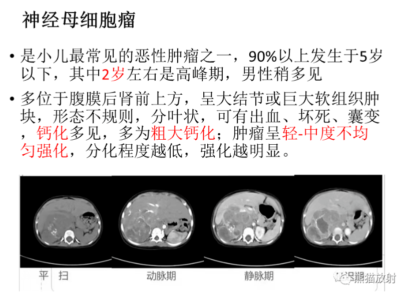 影像PPT - 【病例】肾上腺节细胞神经母细胞瘤1例CT影像-11 影像PPT - 【病例】肾上腺节细胞神经母细胞瘤1例CT影像-11