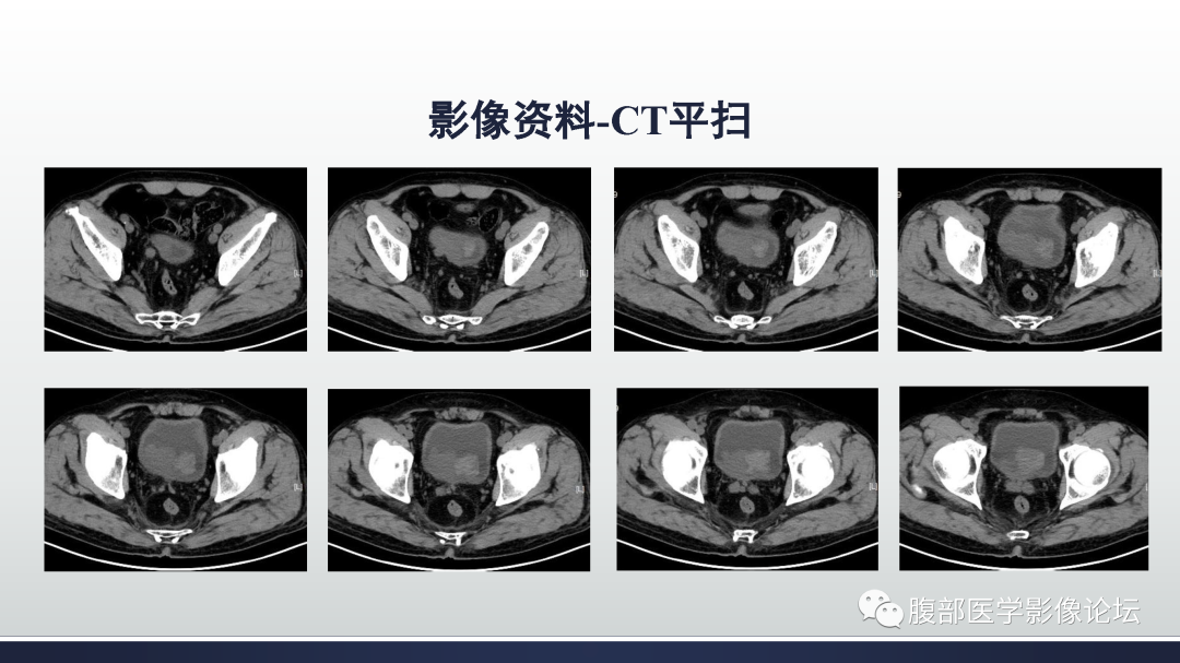 影像PPT - 【病例】膀胱癌—高级别浸润性尿路上皮癌1例CT及MR影像诊断及鉴别-3