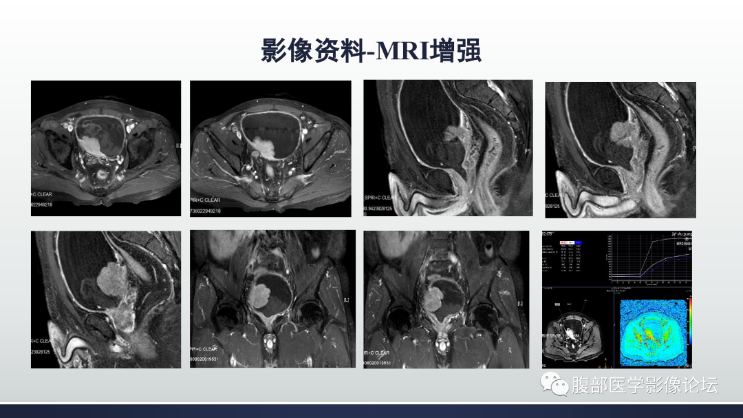 影像PPT - 【病例】膀胱癌—高级别浸润性尿路上皮癌1例CT及MR影像诊断及鉴别-5