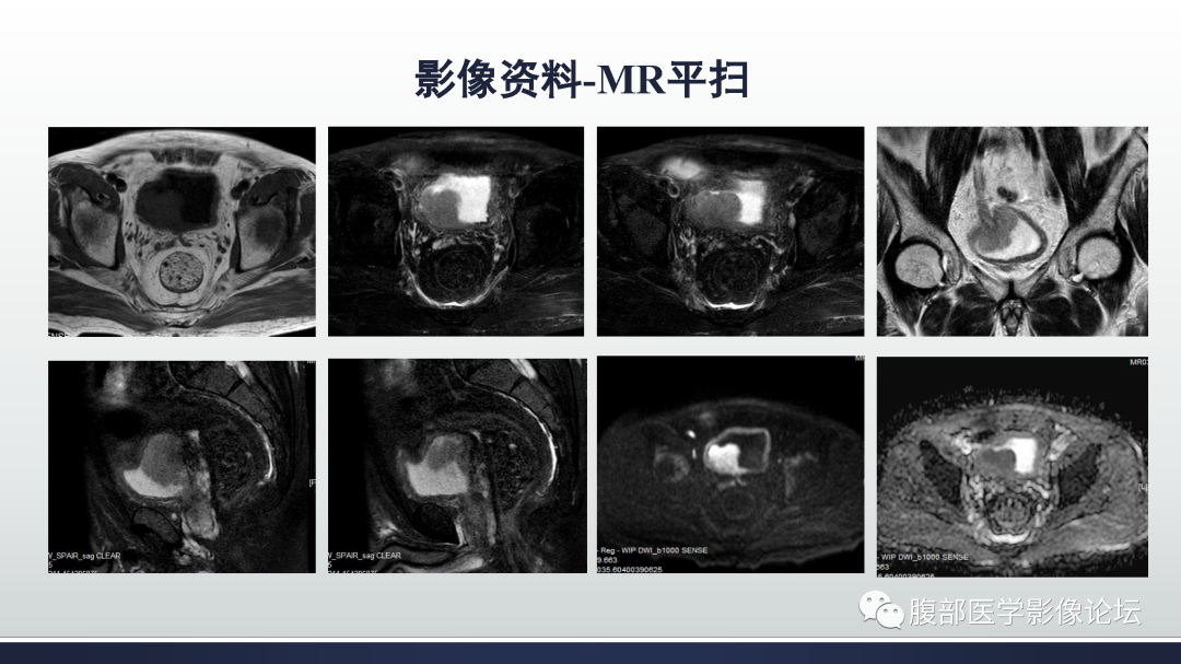 影像PPT - 【病例】膀胱癌—高级别浸润性尿路上皮癌1例CT及MR影像诊断及鉴别-4