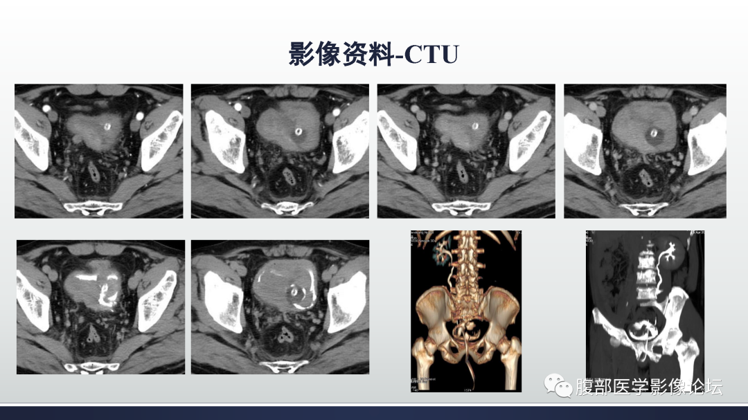 影像PPT - 【病例】膀胱癌—高级别浸润性尿路上皮癌1例CT及MR影像诊断及鉴别-6