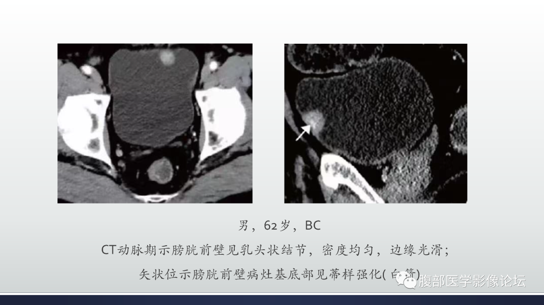 影像PPT - 【病例】膀胱癌—高级别浸润性尿路上皮癌1例CT及MR影像诊断及鉴别-16