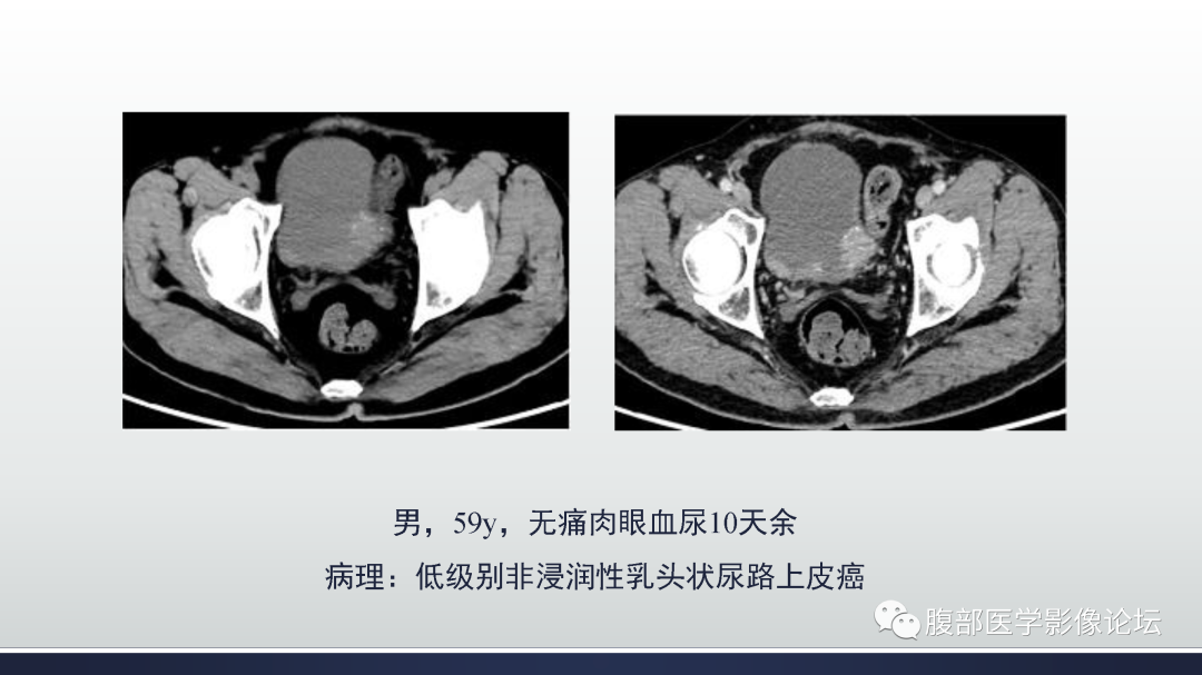 影像PPT - 【病例】膀胱癌—高级别浸润性尿路上皮癌1例CT及MR影像诊断及鉴别-17