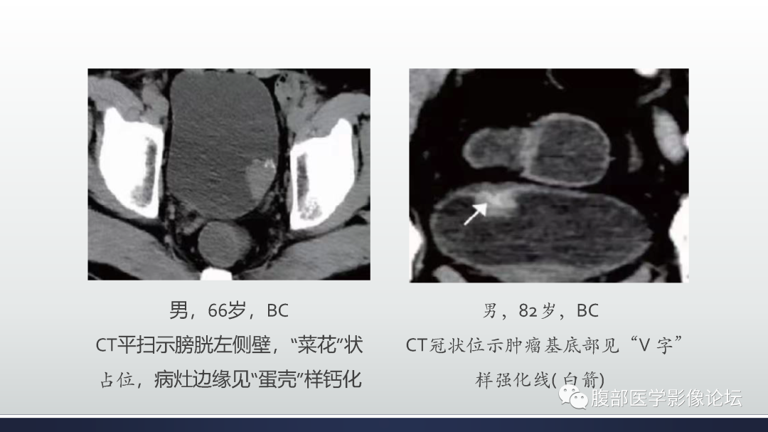 影像PPT - 【病例】膀胱癌—高级别浸润性尿路上皮癌1例CT及MR影像诊断及鉴别-18