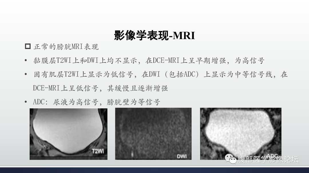 影像PPT - 【病例】膀胱癌—高级别浸润性尿路上皮癌1例CT及MR影像诊断及鉴别-19