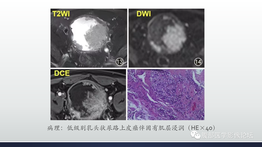影像PPT - 【病例】膀胱癌—高级别浸润性尿路上皮癌1例CT及MR影像诊断及鉴别-21