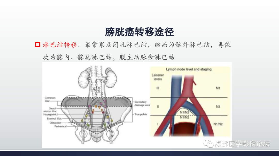 影像PPT - 【病例】膀胱癌—高级别浸润性尿路上皮癌1例CT及MR影像诊断及鉴别-23