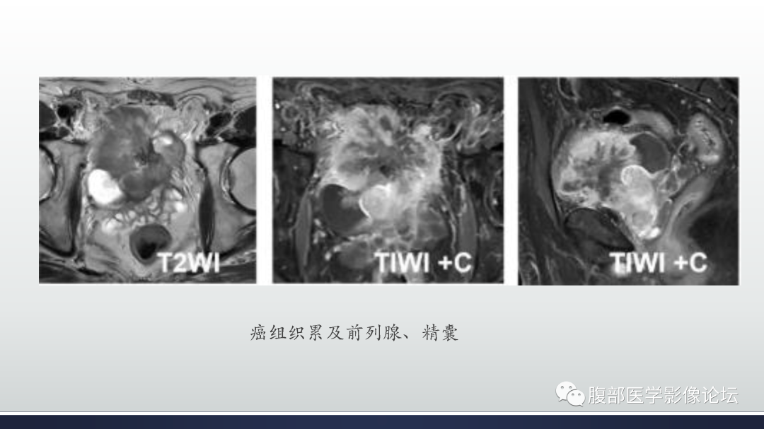 影像PPT - 【病例】膀胱癌—高级别浸润性尿路上皮癌1例CT及MR影像诊断及鉴别-22