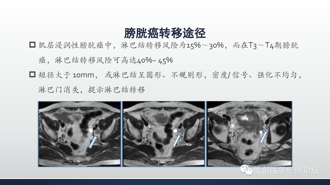 影像PPT - 【病例】膀胱癌—高级别浸润性尿路上皮癌1例CT及MR影像诊断及鉴别-24