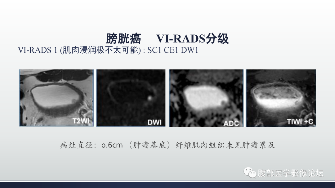 影像PPT - 【病例】膀胱癌—高级别浸润性尿路上皮癌1例CT及MR影像诊断及鉴别-31