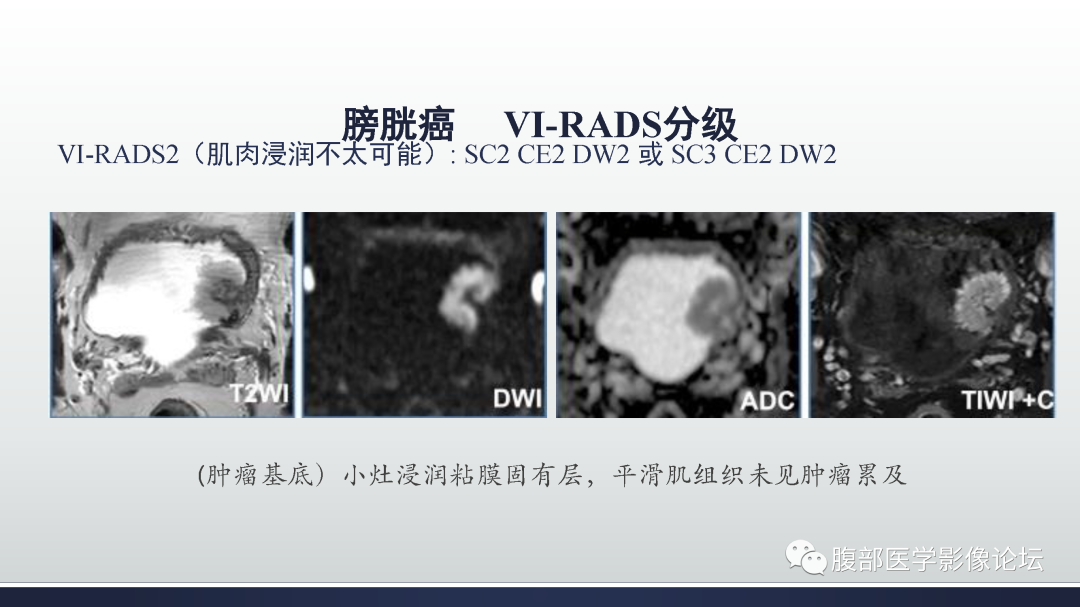 影像PPT - 【病例】膀胱癌—高级别浸润性尿路上皮癌1例CT及MR影像诊断及鉴别-32