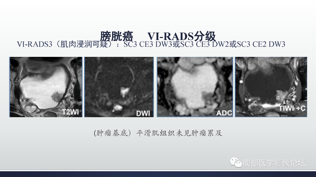 影像PPT - 【病例】膀胱癌—高级别浸润性尿路上皮癌1例CT及MR影像诊断及鉴别-33