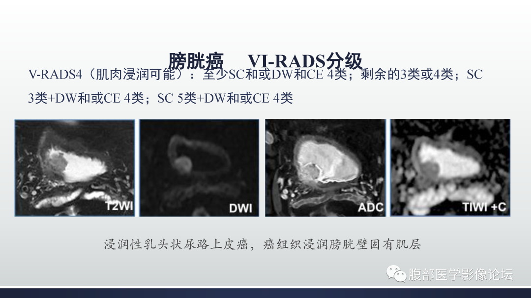 影像PPT - 【病例】膀胱癌—高级别浸润性尿路上皮癌1例CT及MR影像诊断及鉴别-34