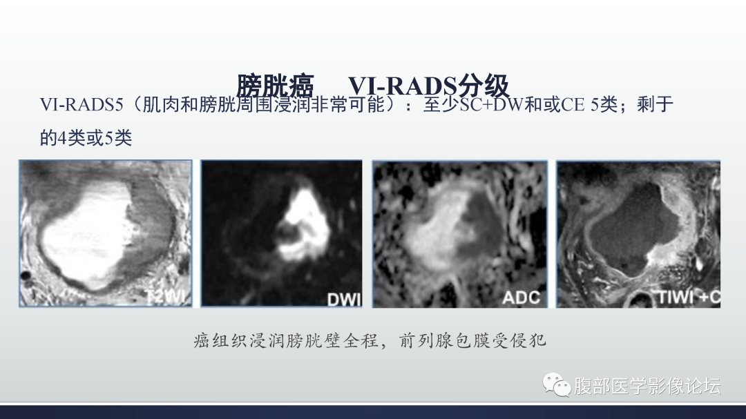影像PPT - 【病例】膀胱癌—高级别浸润性尿路上皮癌1例CT及MR影像诊断及鉴别-35