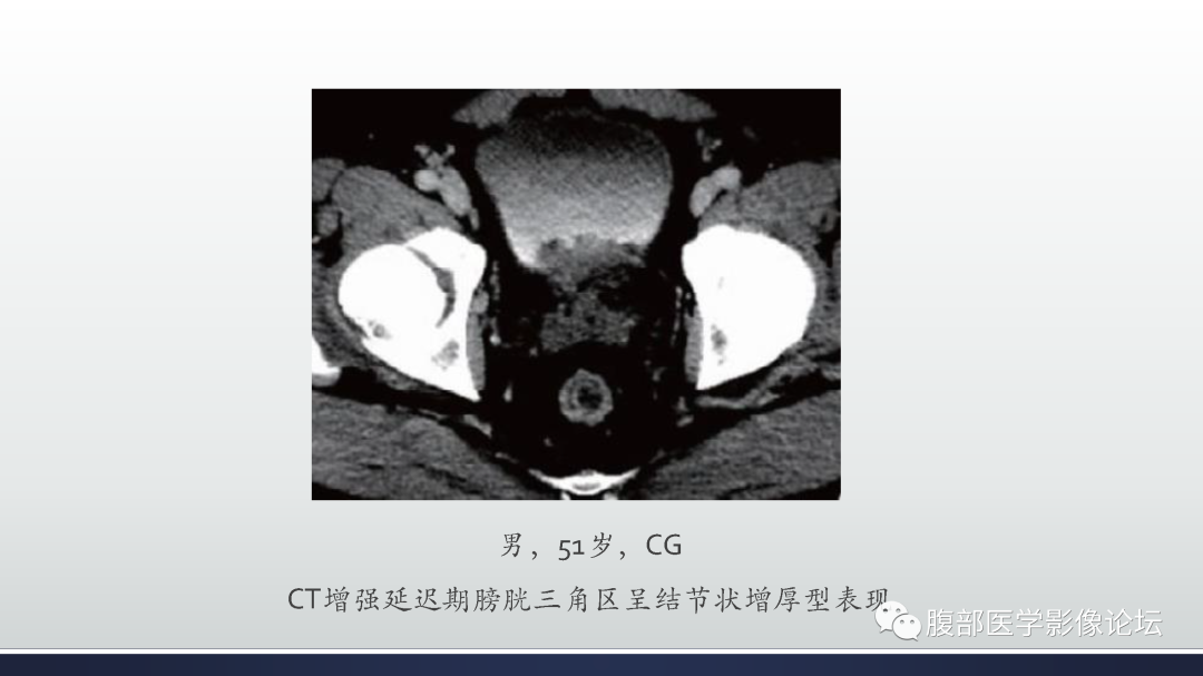 影像PPT - 【病例】膀胱癌—高级别浸润性尿路上皮癌1例CT及MR影像诊断及鉴别-39