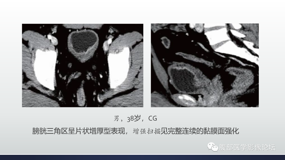 影像PPT - 【病例】膀胱癌—高级别浸润性尿路上皮癌1例CT及MR影像诊断及鉴别-40