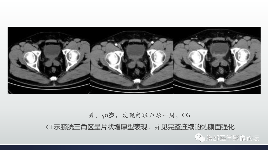 影像PPT - 【病例】膀胱癌—高级别浸润性尿路上皮癌1例CT及MR影像诊断及鉴别-42