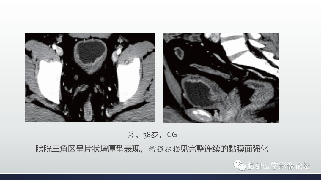 影像PPT - 【病例】膀胱癌—高级别浸润性尿路上皮癌1例CT及MR影像诊断及鉴别-41
