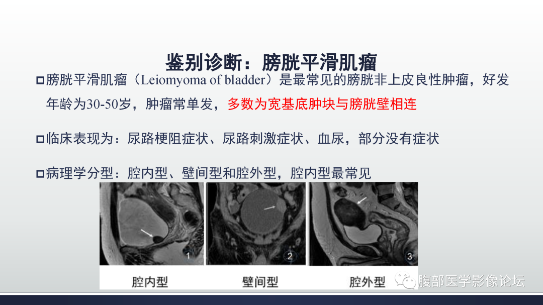 影像PPT - 【病例】膀胱癌—高级别浸润性尿路上皮癌1例CT及MR影像诊断及鉴别-43