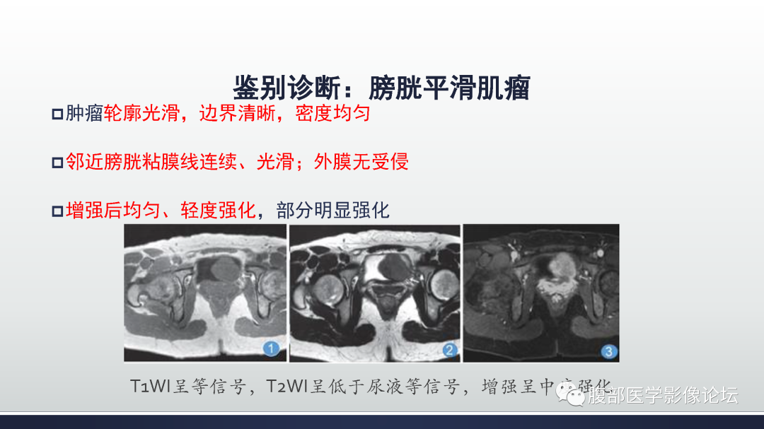 影像PPT - 【病例】膀胱癌—高级别浸润性尿路上皮癌1例CT及MR影像诊断及鉴别-44