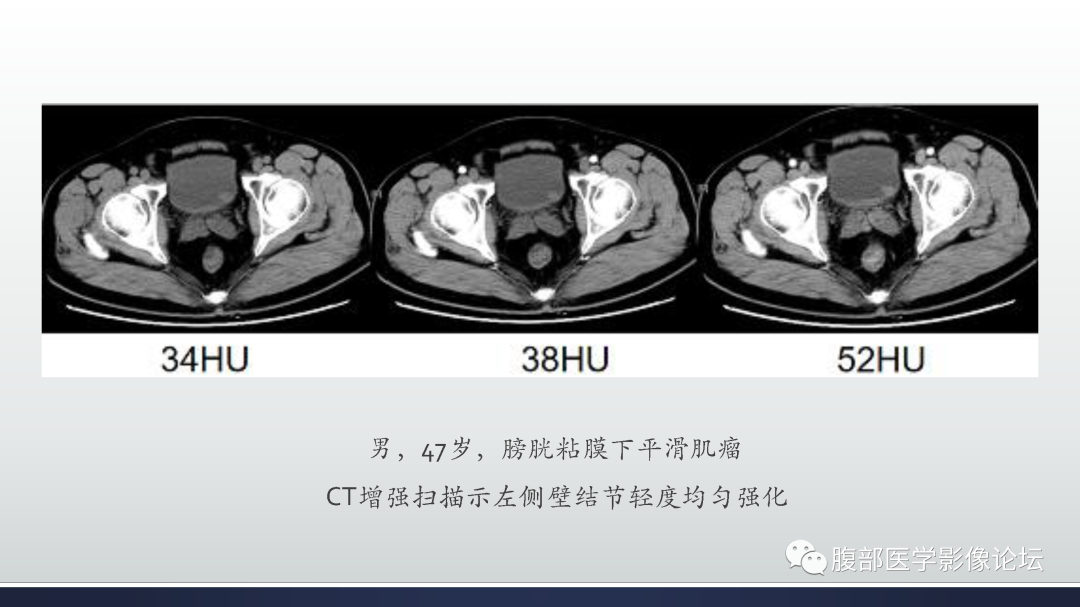 影像PPT - 【病例】膀胱癌—高级别浸润性尿路上皮癌1例CT及MR影像诊断及鉴别-45