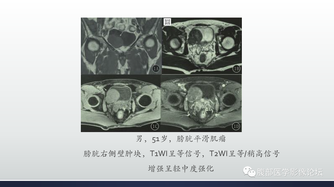 影像PPT - 【病例】膀胱癌—高级别浸润性尿路上皮癌1例CT及MR影像诊断及鉴别-46