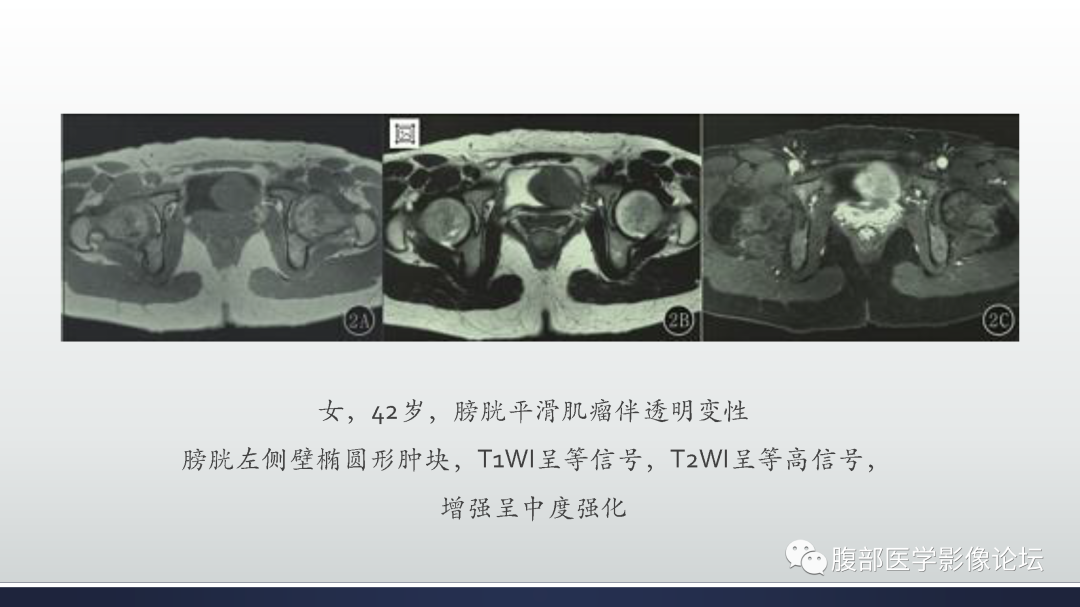 影像PPT - 【病例】膀胱癌—高级别浸润性尿路上皮癌1例CT及MR影像诊断及鉴别-47