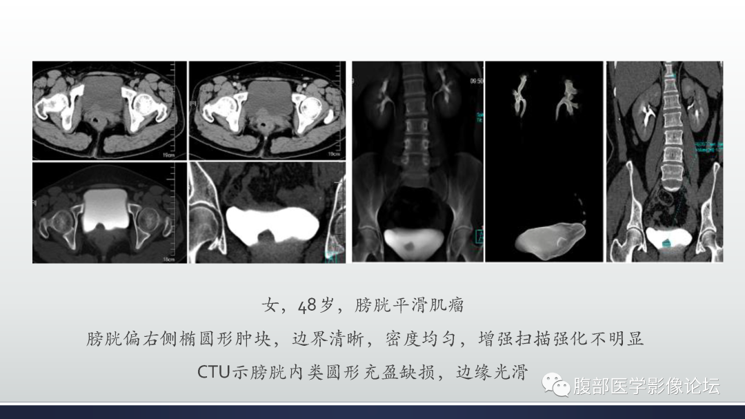 影像PPT - 【病例】膀胱癌—高级别浸润性尿路上皮癌1例CT及MR影像诊断及鉴别-48