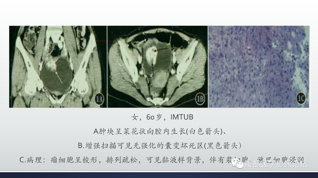 影像PPT - 【病例】膀胱癌—高级别浸润性尿路上皮癌1例CT及MR影像诊断及鉴别-51