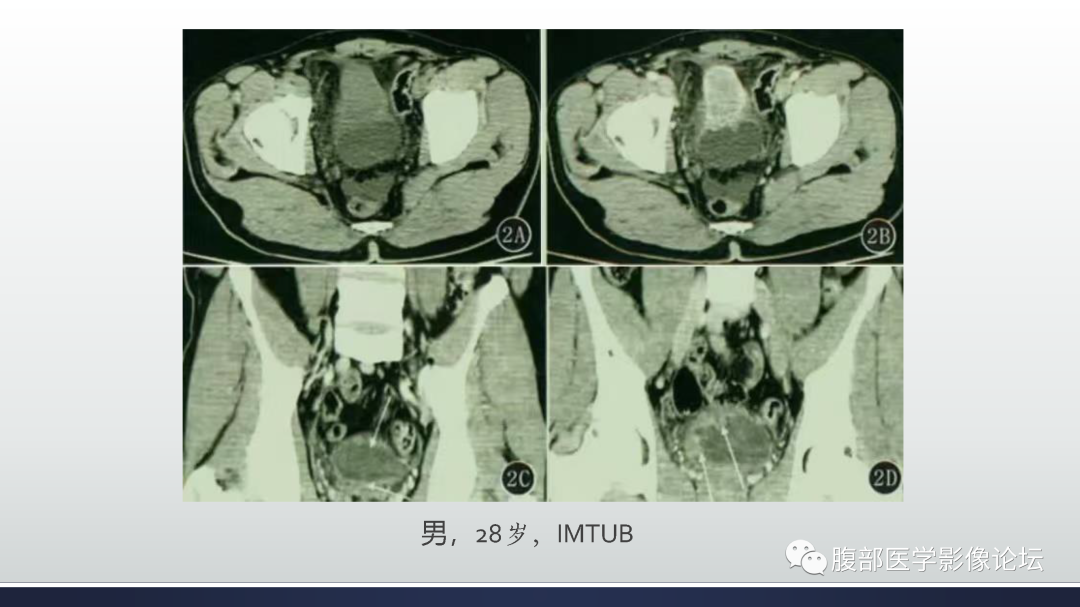 影像PPT - 【病例】膀胱癌—高级别浸润性尿路上皮癌1例CT及MR影像诊断及鉴别-52