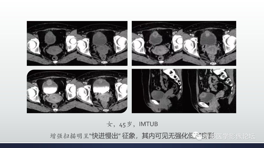 影像PPT - 【病例】膀胱癌—高级别浸润性尿路上皮癌1例CT及MR影像诊断及鉴别-53