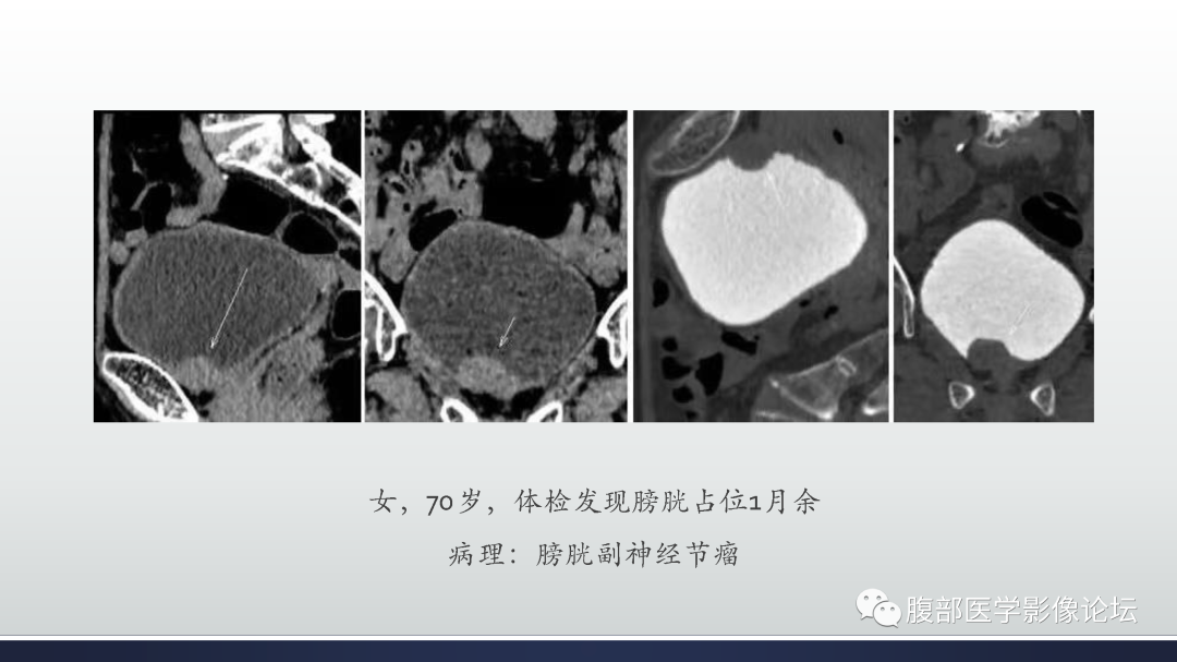影像PPT - 【病例】膀胱癌—高级别浸润性尿路上皮癌1例CT及MR影像诊断及鉴别-56