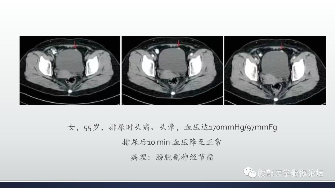 影像PPT - 【病例】膀胱癌—高级别浸润性尿路上皮癌1例CT及MR影像诊断及鉴别-57