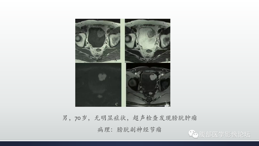 影像PPT - 【病例】膀胱癌—高级别浸润性尿路上皮癌1例CT及MR影像诊断及鉴别-58