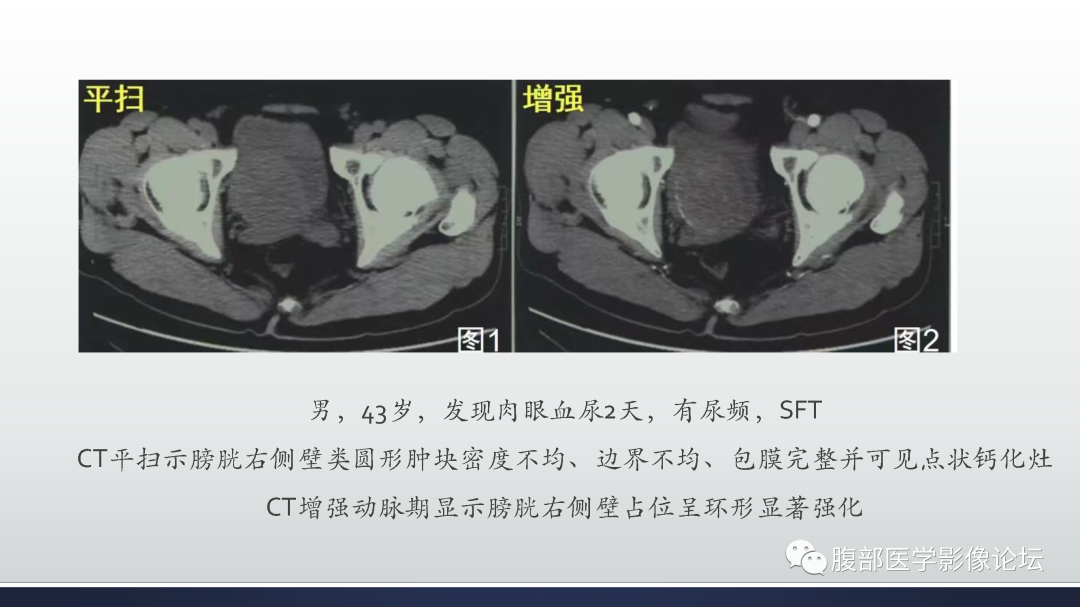 影像PPT - 【病例】膀胱癌—高级别浸润性尿路上皮癌1例CT及MR影像诊断及鉴别-61