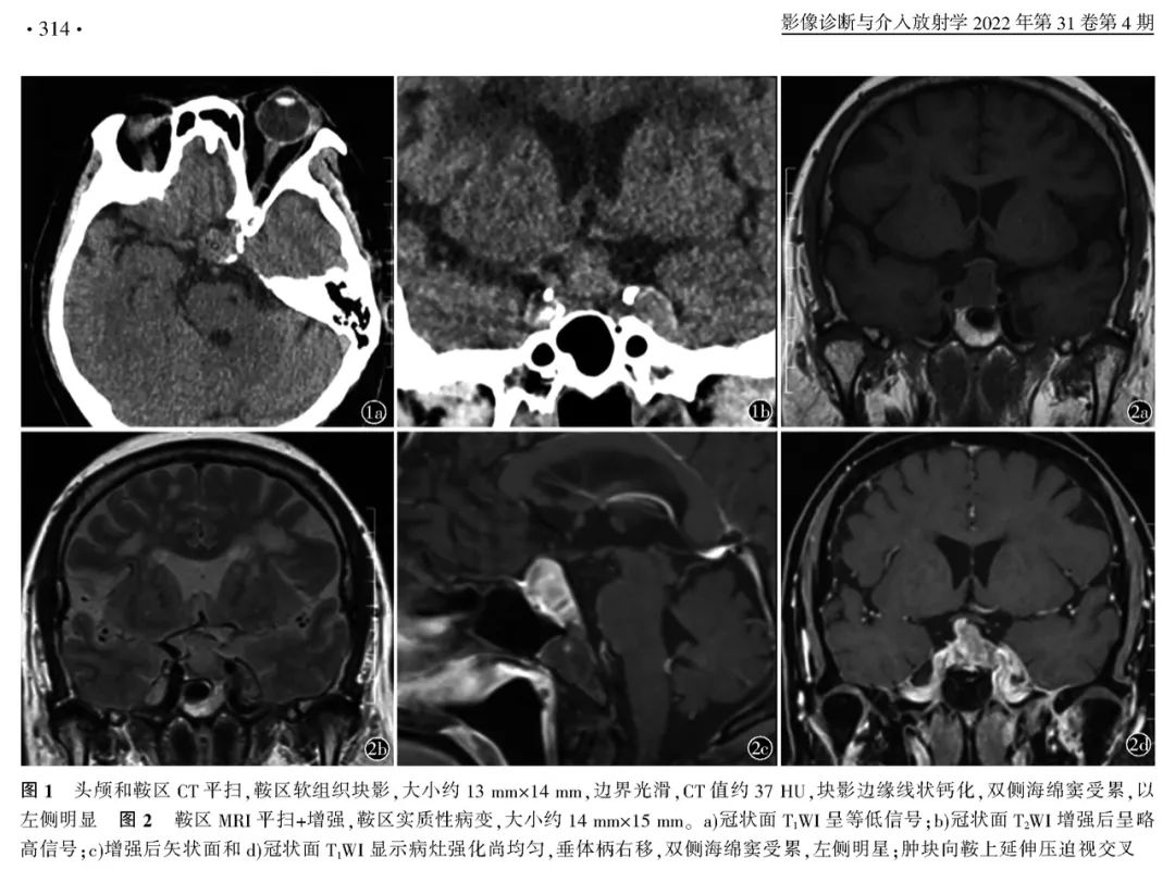 影像PPT - 【病例】鞍区恶性肿瘤—非典型畸胎样/横纹肌样肿瘤1例CT及MR影像诊断思维-4
